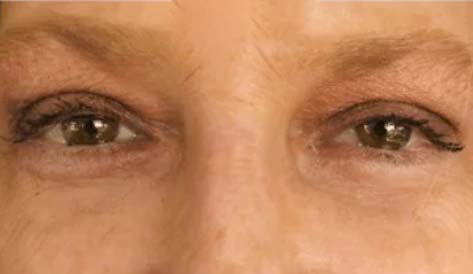 TN Oculoplastics AFTER - Cosmetic eyelid surgery for droopy eyelids - eyelid lift in Nashville, TN