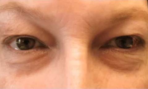 TN Oculoplastics BEFORE - Cosmetic eyelid surgery for droopy eyelids - eyelid lift in Nashville, TN